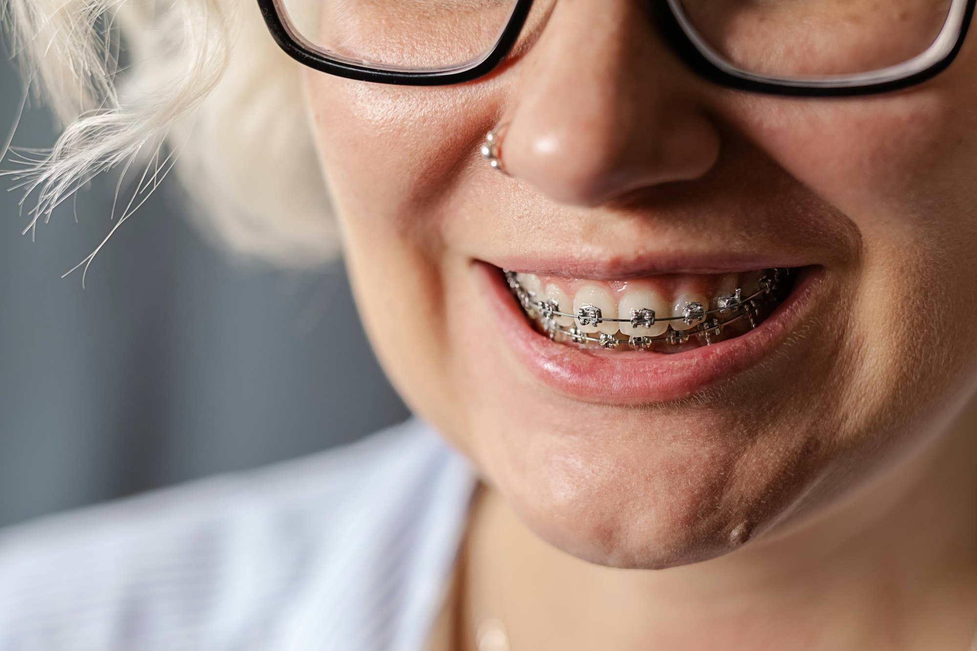 teeth of a young woman with braces close-up